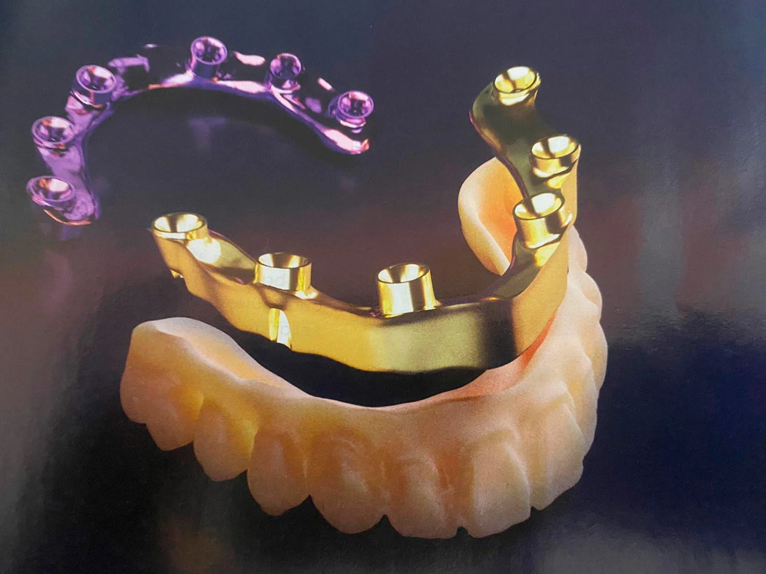 implantes