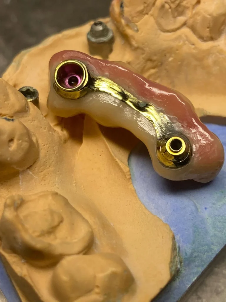 implantes3